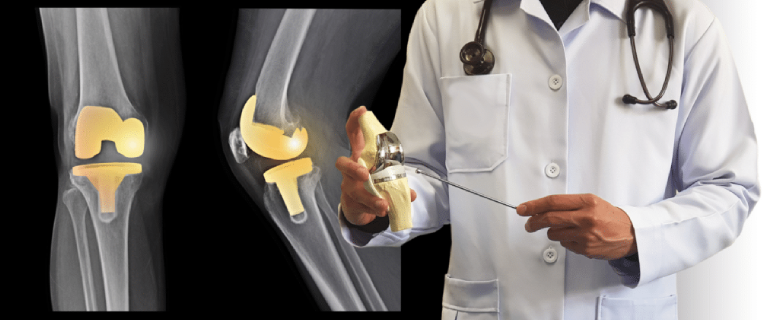 Joint Replacement Surgery