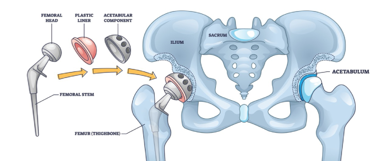 Hip Replacement Surgeon in Ranchi