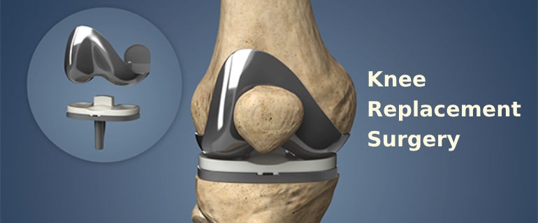 Knee Replacement Surgery
